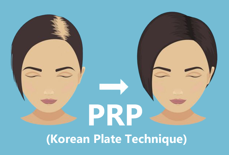 PRP (Korean Plate Technique)