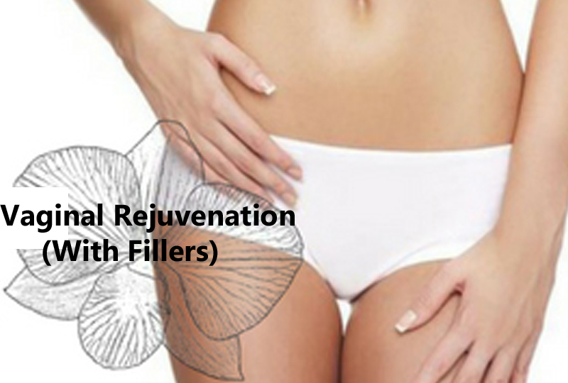 Vaginal Rejuvenation (With Fillers)