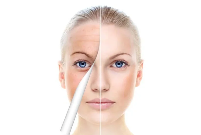 CO2 Fractional Laser