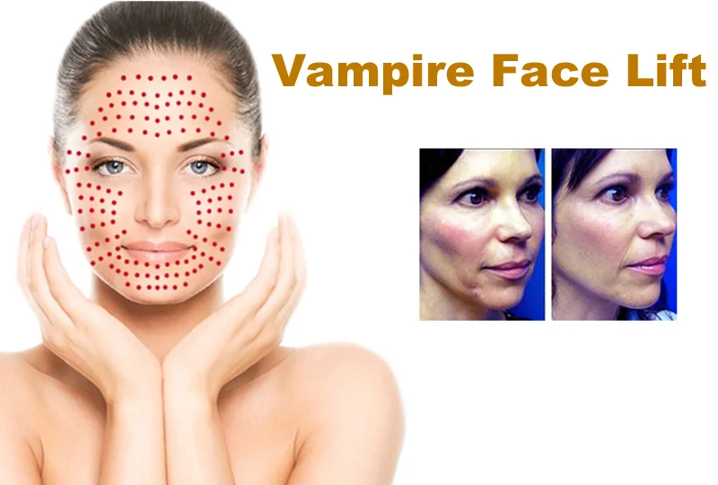 Vampire Facelift