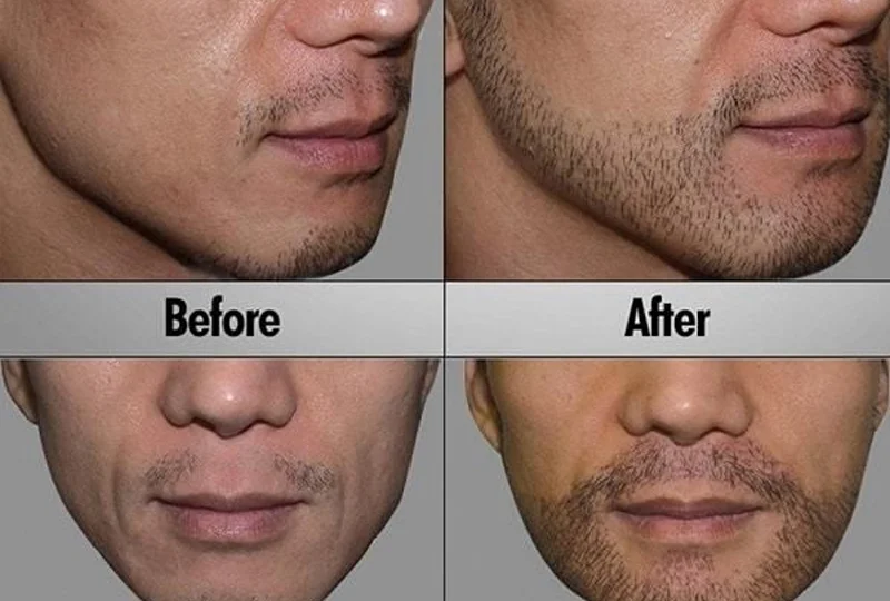 Beard Transplantation